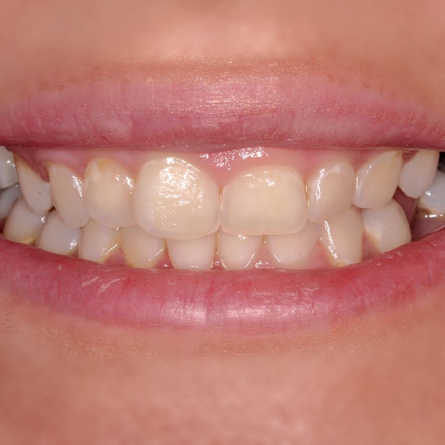 gum surgery - gum disease - before - 3Dental